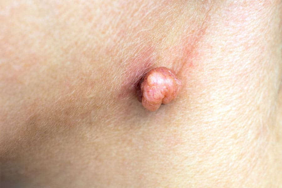 HPV-tratamento-ginecologia